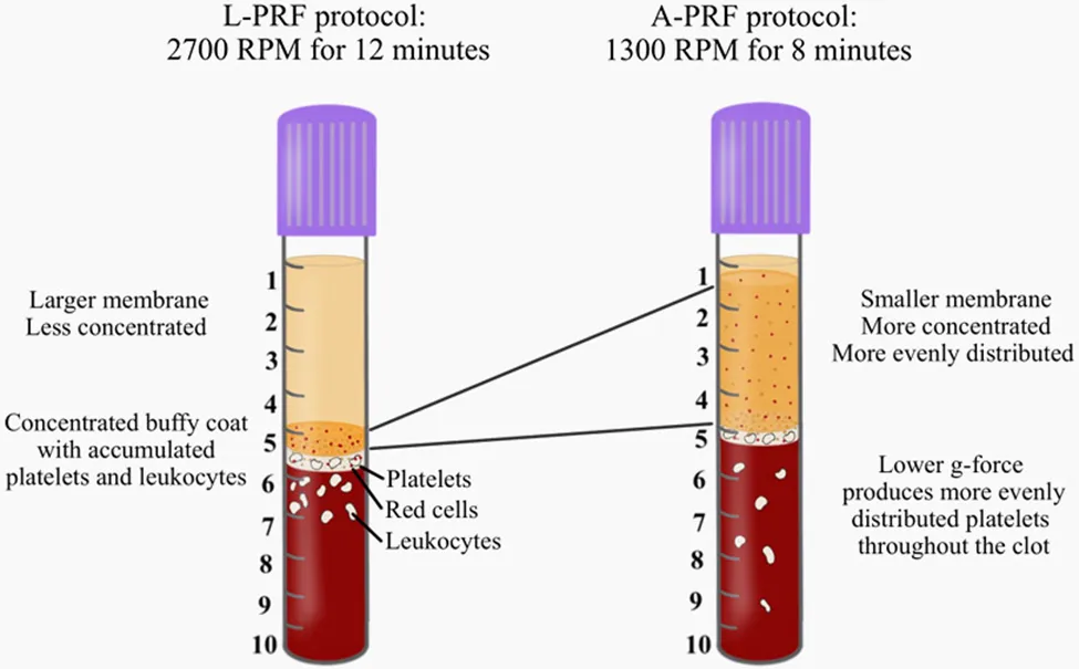PRF injection procedure for TMJ joint therapy